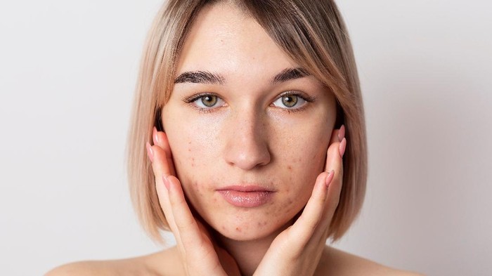 BeauPicks: 3 Pilihan Serum dari Brand Lokal Somethinc untuk Pudarkan Noda Bekas Jerawat