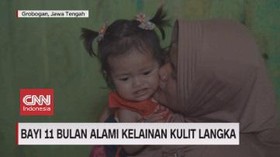 VIDEO: Bayi 11 Bulan Alami Kelainan Kulit Langka