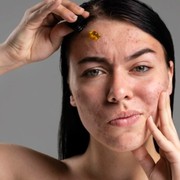 4 Cara Mudah Atasi Flek Hitam Supaya Kulit Wajah Sehat dan Bersih