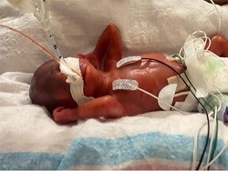 Kisah Bayi Paling Prematur di Dunia, Lahir di Usia Kehamilan Ibunya 21 Minggu