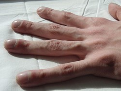 Viral Bentuk Kuku Tak Biasa Disebut Clubbing Finger, Pertanda Penyakit Jantung?