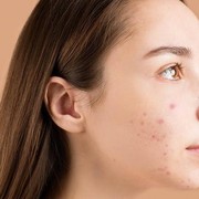 Ingin Atasi Jerawat? Perpaduan Salicylic Acid dan Tea Tree dalam Rangkaian Skincare Ini Bisa Jadi Solusi!