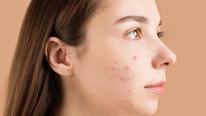 Ingin Atasi Jerawat? Perpaduan Salicylic Acid dan Tea Tree dalam Rangkaian Skincare Ini Bisa Jadi Solusi!