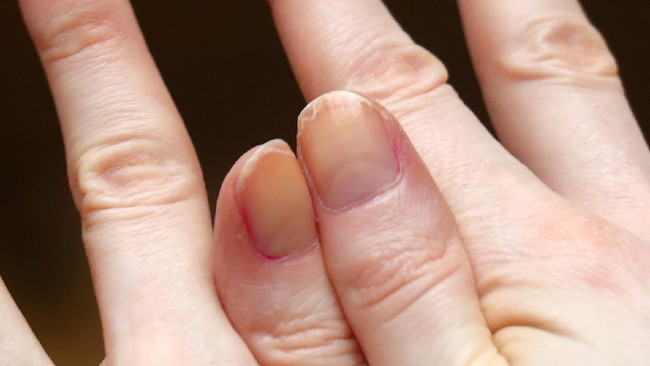 Awas, 3 Kondisi Kuku Ini Bisa Jadi Gejala Diabetes Ada banyak gejala diabetes yang diperlihatkan oleh tubuh. Salah satunya melalui kuku.