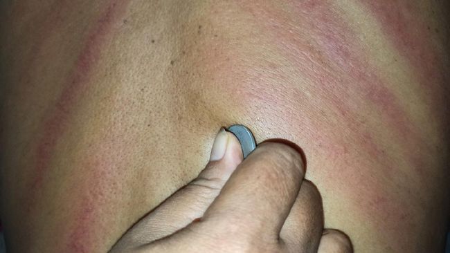 Rona merah yang muncul di permukaan kulit setelah kerokan bukan tanda angin yang keluar. Lantas, apa itu rona merah di punggung yang muncul setelah kerokan?