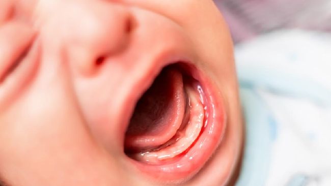 Sebuah studi mengungkapkan kerusakan otak pada bayi baru lahir akibat Covid-19. Studi ini sekaligus juga menunjukkan bahwa virus corona bisa menembus plasenta.