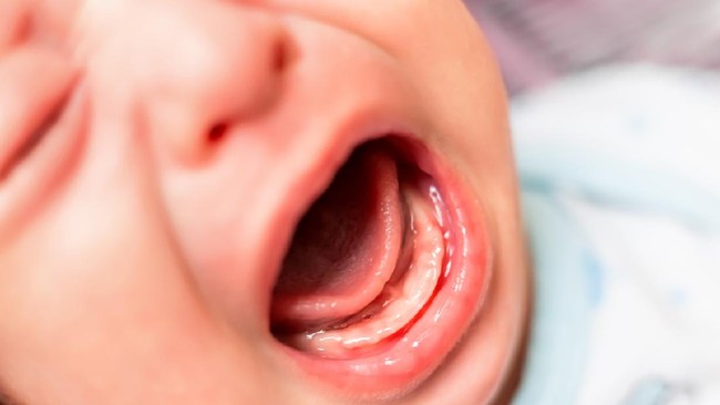 Kabar seorang balita yang dikerok tengah viral di media sosial. Amankah memberikan kerokan pada bayi?