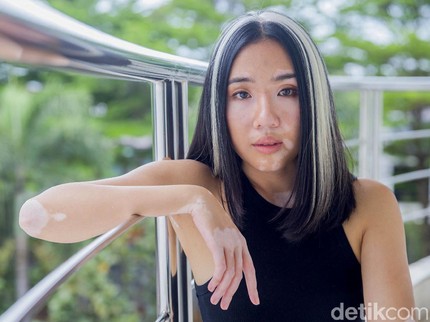 Cerita Model Zsazsa Caesar Idap Vitiligo, Dibully & Disebut Anak Hasil Pesugihan