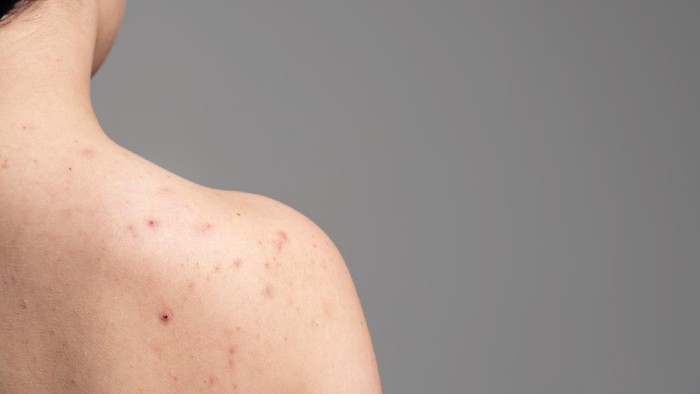 Jerawat Punggung, Never Ending Skin Problem yang Nggak Boleh Kamu Sepelekan!