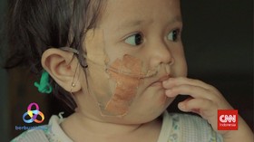 VIDEO: Bantu Eliza yang Memiliki Kelainan Langka Lewat Berbuat Baik