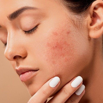 img-title Ampuh Hempaskan Jerawat Membandel, Cobain 6 Rekomendasi Produk Acne Spot Care Lokal Terlaris Sepanjang 2021!