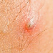 Ingrown Hair: Rambut yang Tumbuh ke Dalam Kulit, Berbahayakah?