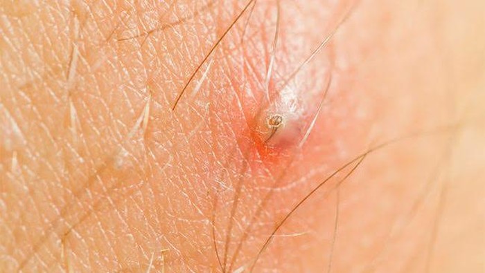 Ingrown Hair: Rambut yang Tumbuh ke Dalam Kulit, Berbahayakah?