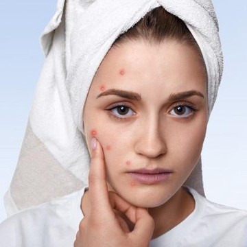 img-title Pertolongan Pertama Saat Jerawatan, Lebih Efektif Acne Patch atau Acne Spot Gel?