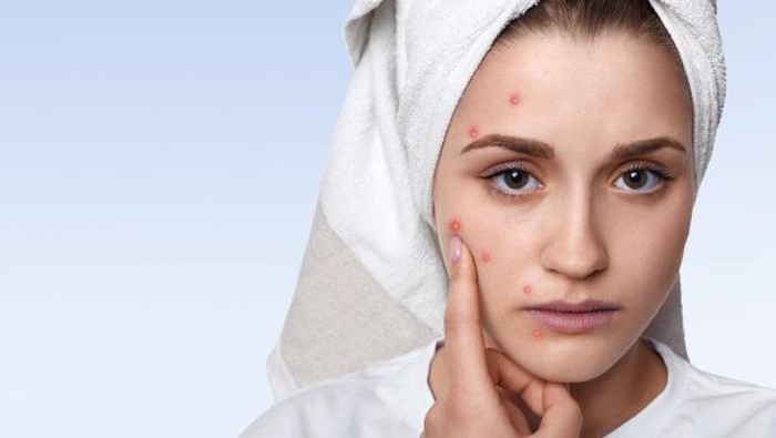 Pertolongan Pertama Saat Jerawatan, Lebih Efektif Acne Patch atau Acne Spot Gel?