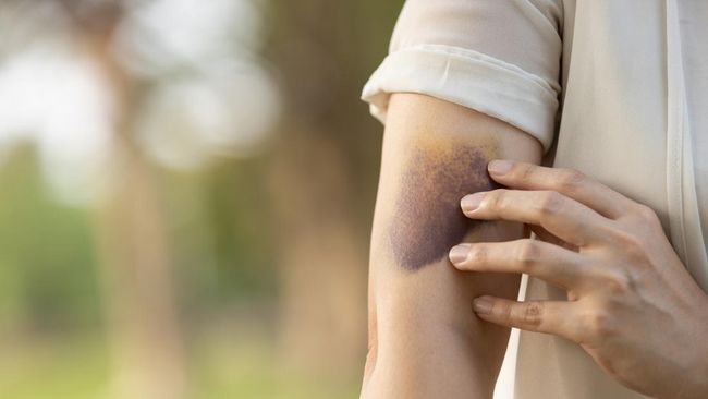 Apabila memar muncul di permukaan kulit, Anda bisa menghilangkannya sendiri dengan mudah. Simak cara menghilangkan memar dengan bahan alami.