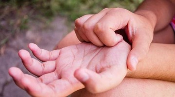 STEROID DAPAT MENYEBABKAN STRETCH MARK HINGGA GLAUKOMA