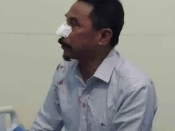 Duduk Perkara Eks Bupati Digigit Hidungnya hingga Pelaku Jadi Tersangka