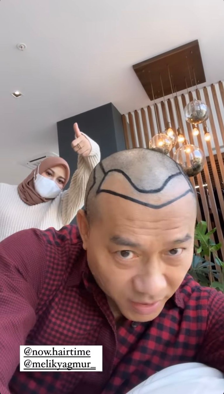 7 Penampilan Terbaru & Beda Anang Hermansyah dengan Rambut Botak Anang Hermansyah memamerkan rambut barunya yang sangat beda saat liburan di Turkey. Yuk intip potretnya!