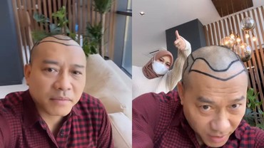 img-title Anang Hermansyah Transplantasi Rambut, Kevin Aprilio: Mantap