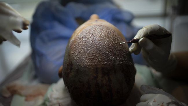Tidak semua orang bisa menjalani transplantasi rambut. Beberapa faktor dalam tubuh bisa bikin Anda gagal transplantasi.