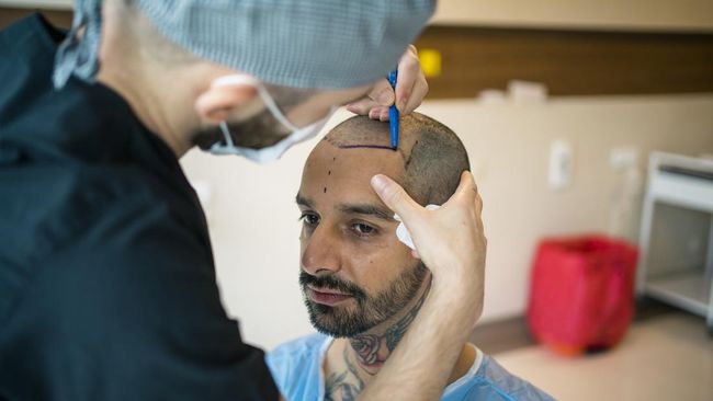 Risiko dan Biaya Transplantasi Rambut Seperti yang Dilakukan Anang Anang Hermansyah melakukan prosedur cangkok rambut atau transplantasi rambut saat berlibur ke Turki. Berapa harganya dan apa risikonya?