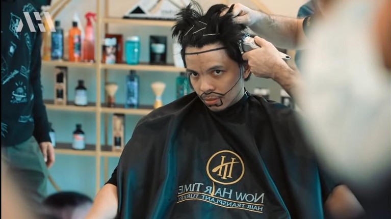7 Potret Atta Halilintar Transplantasi Rambut Susul Anang Hermansyah, Atta Halilintar juga mengubah penampilannya dengan transplantasi rambut. Yuk intip!