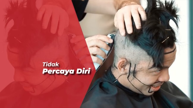 Ikuti Anang Hermansyah, Atta Halilintar Jalani Transplantasi Rambut