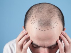 Mengenal Proses Transplantasi Rambut yang Lagi Ngetren