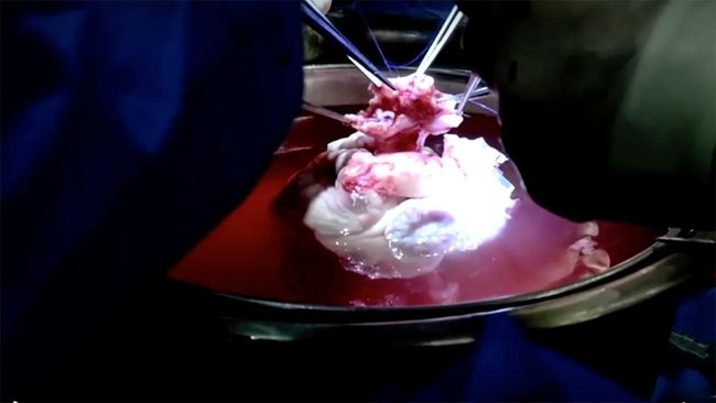 Pusat Medis Universitas Maryland mengumumkan seorang warga bernama Lawrence Faucette (58) berhasil menerima transplantasi jantung babi pada Jumat (22/9).