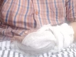 Polisi Buru Pria Diduga Penyiram Air Keras Ibu-Anak di Palembang