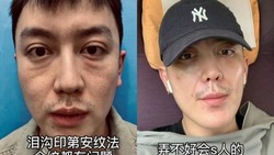 img-title Gagal Oplas, Wajah Selebgram Pria Malah Jadi Lebih Tua 20 Tahun