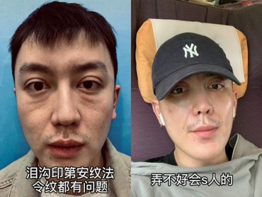 Gagal Oplas, Wajah Selebgram Pria Malah Jadi Lebih Tua 20 Tahun