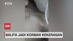 VIDEO: Balita Jadi Korban Kekerasan dengan Cara Disundut Api