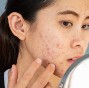 BeauPicks: Rekomendasi Serum Lokal yang Ampuh Menghilangkan Flek Hitam Bekas Jerawat