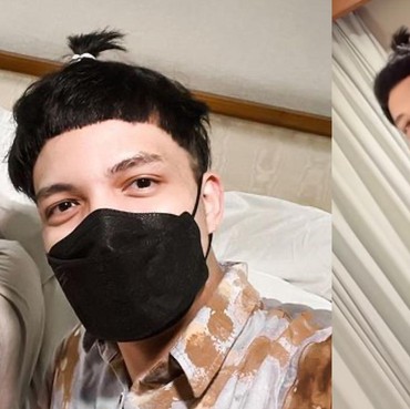 7 Potret Atta Halilintar Tampil Tanpa Bandana Usai Transplantasi Rambut