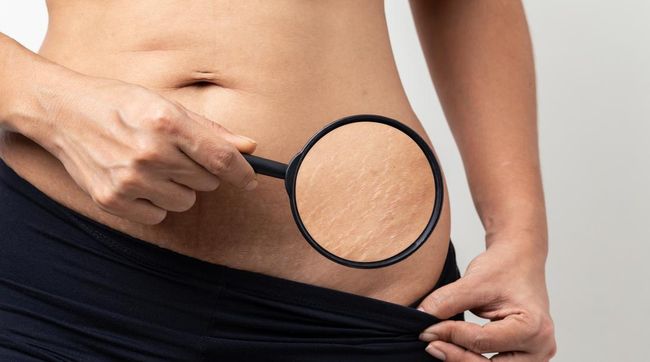 Meski problem kulit ini tidak berbahaya dan menyakitkan, namun stretch mark yang muncul bikin jadi tidak percaya diri. Berikut penyebab stretch mark di kulit.