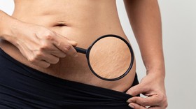5 Kebiasaan yang Bisa Cegah Stretch Mark Saat Hamil