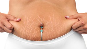 5 Cara Memudarkan Stretch Mark