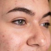 5 Bahan Alami yang Bisa Membantu Pudarkan Flek Hitam Menurut Ahli