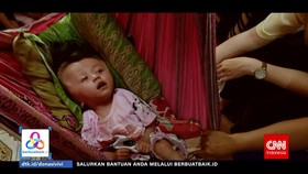 VIDEO: Bantu Operasi Vivi Balita Hidrosefalus via BerbuatBaik.id