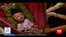VIDEO: Bantu Pengobatan Vivi lewat Berbuatbaik.id