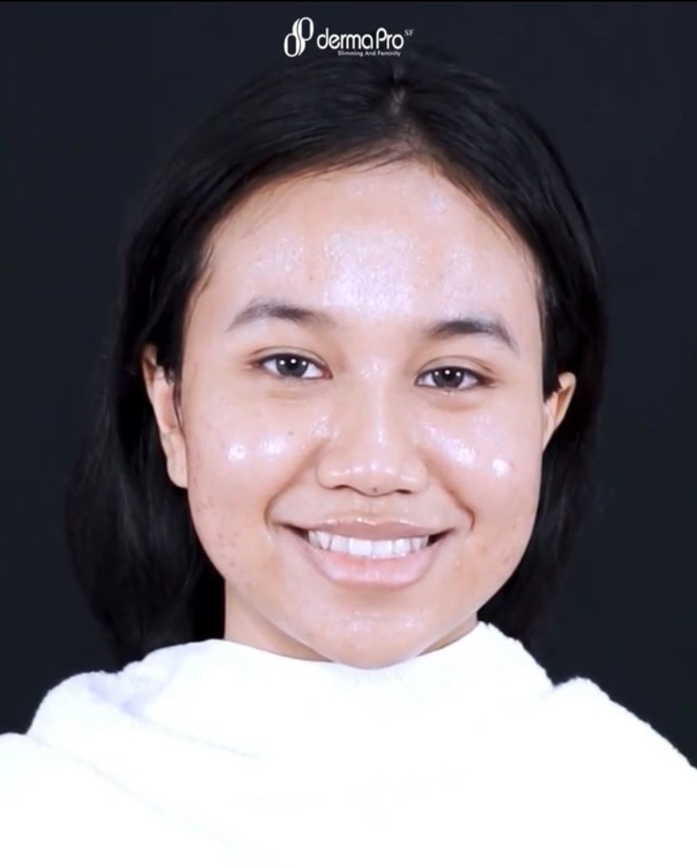 8 Potret Transformasi Mayang Mayang baru-baru ini melakukan perawatan wajah hingga habiskan Rp80 juta. Yuk kita intip transformasinya yang makin glow up!
