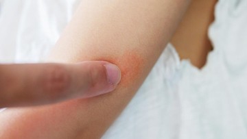 GEJALA DAN PENGOBATAN SCABIES PADA ANAK