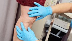 5 Cara Menghilangkan Varises di Kaki secara Alami