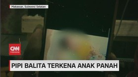 VIDEO: Balita Terkena Panah Busur Di Bagian Pipi