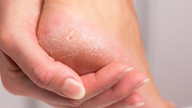 7 Cara Mengatasi Kaki Pecah-Pecah, Bikin Mulus Kembali