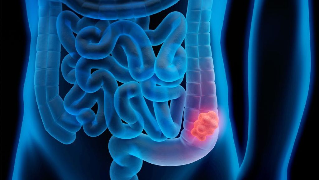 Dokter Ingatkan Hindari Makanan Ini Sejak Dini untuk Cegah Kanker Usus
