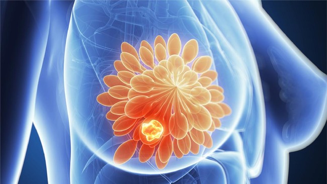 Kanker payudara yang merupakan salah satu penyebab kematian tertinggi di Indonesia sebenarnya bisa sembuh, asal terdeteksi sejak awal.