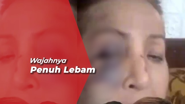 Jadi Korban Tabrak Lari, Kondisi Machica Mochtar Memprihatinkan